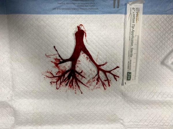 intact-blood-clot-that-was-attached-to-the-ett-of-a-terminally-extubated-covid-patient_001